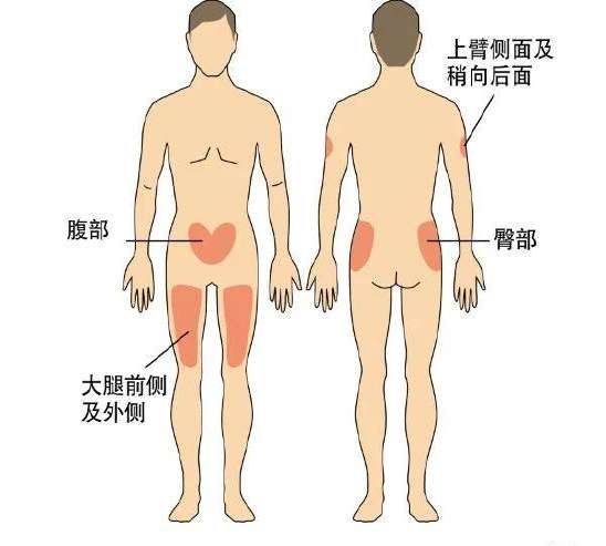 胰岛素注射部位.jpg